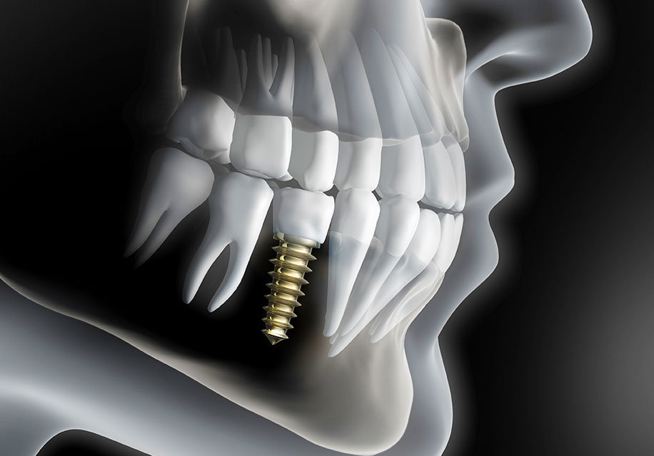 お口の中を立体的に把握できるCT撮影で、精密なインプラント手術を行ないます